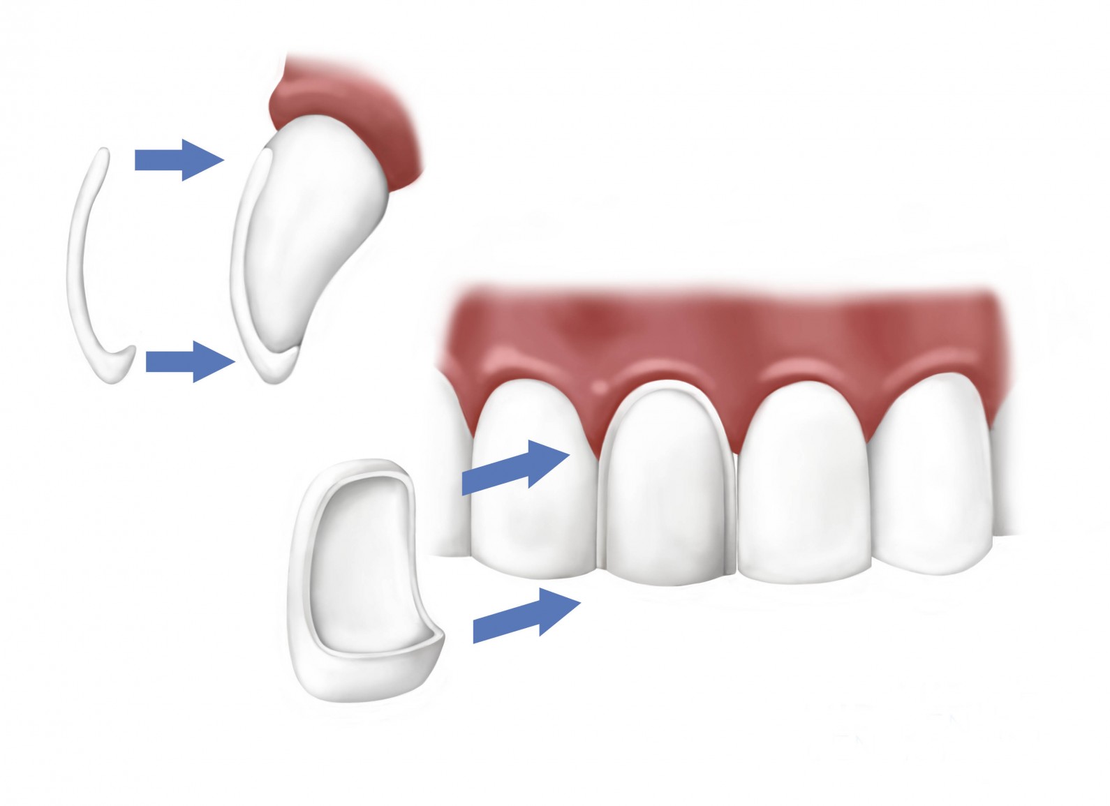 veneers
